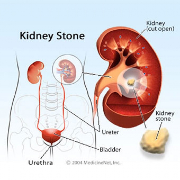 गुर्दे की पथरी (Kidney Stone)