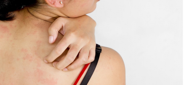 घमौरियां (Prickly Heat)